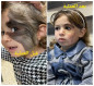 فريق طبي في مستشفى الواسطي ينجح برفع وحمة شعرية ولادية في الوجه لطفلة بعمر  3 سنوات