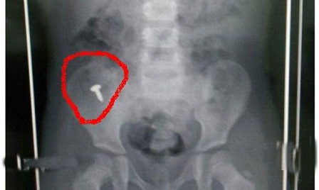 بالصور..عجوز تخرج مسماراً من بطن طفلة أعجز الأطباء