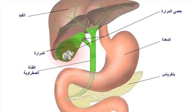 وصفة طبيعية لاخراج حصى المرارة خلال 24 ساعة فقط  دون عملية جراحية.