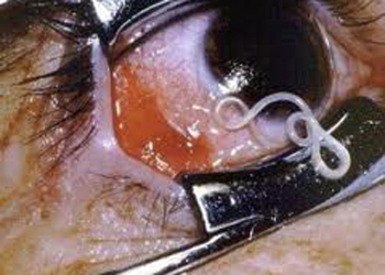 طبيب يسحب دودة حيّة طولها 13 سم من عين مريض+صورة