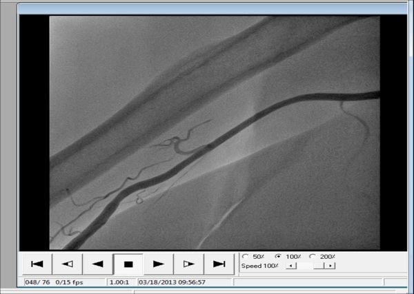 صحة كربلاء: أول عملية قسطرة تشخيصية لشرايين القلب عن طريق الشريان الكعبري