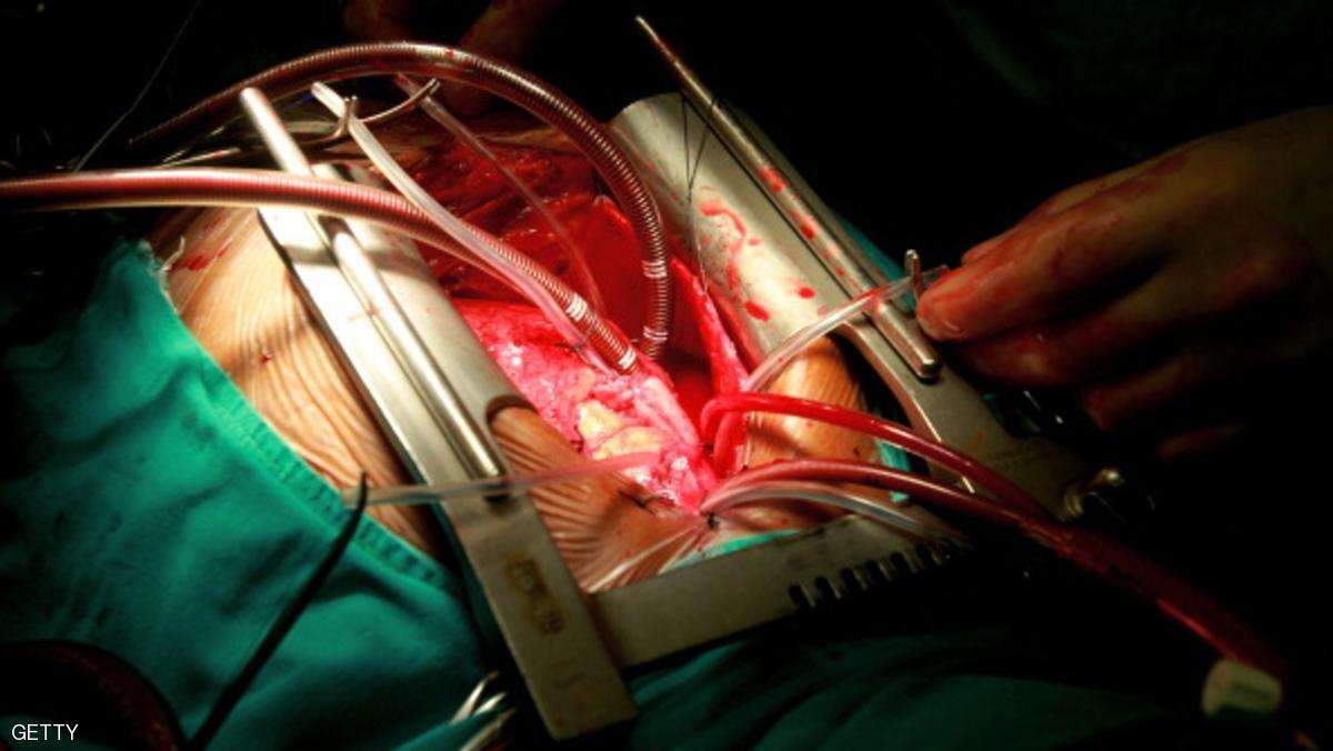 دراسة: استبدال الشريان بالقلب أفضل من الجراحة