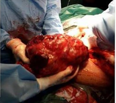 بالصور:في كربلاء إستئصال ورم يزن (4) كغم من بطن مريضة عمرها 77 عاماً