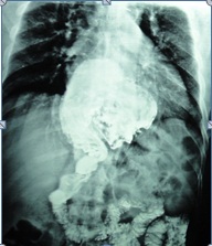 صحة كربلاء:  لأول مرة اجراء عملية تصغير جدار المعدة بالناظور