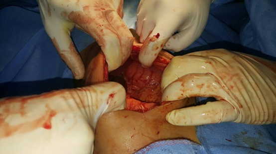 جراحو مدينة الطب يستأصلون المبيض الأيسر لطفلة تعاني من الام حادة بالبطن