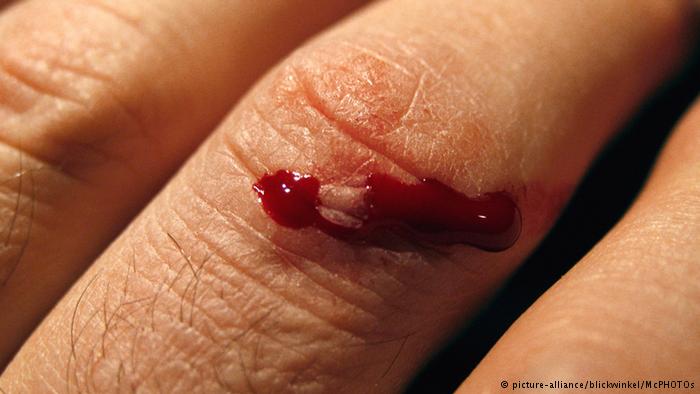 جل "سحري" يوقف النزيف الحاد في ثواني !