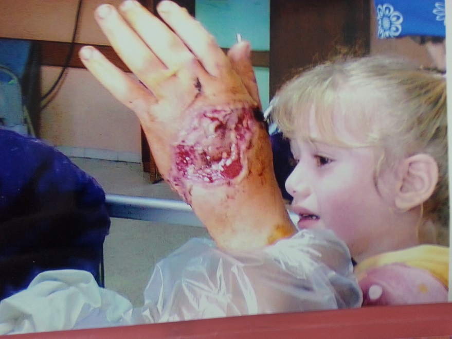 بالصور:مجلس كربلاء يمنح الطفلة (صفا) 10 مليون دينار بعد بتر كفها الايسر ؟