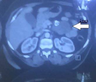 كربلاء: سلخ واستئصال كتلة عن البنكرياس و الوريد الكلوي في مستشفى الامام زين العابدين عليه السلام