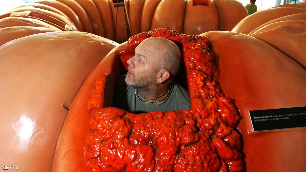 تفادى سرطان القولون في 10 خطوات