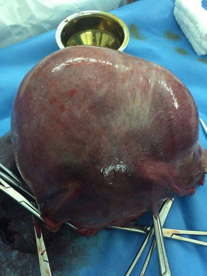 فريق طبي كربلائي ينجح في إستئصال ورم وزنه 2 كغم من بطن مريضة خمسينية