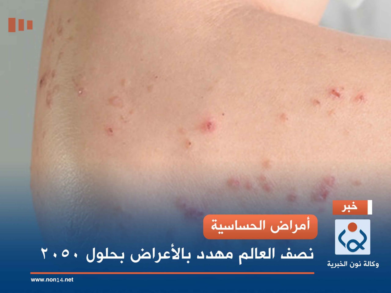 أمراض الحساسية.. نصف العالم مهدد بالأعراض بحلول 2050