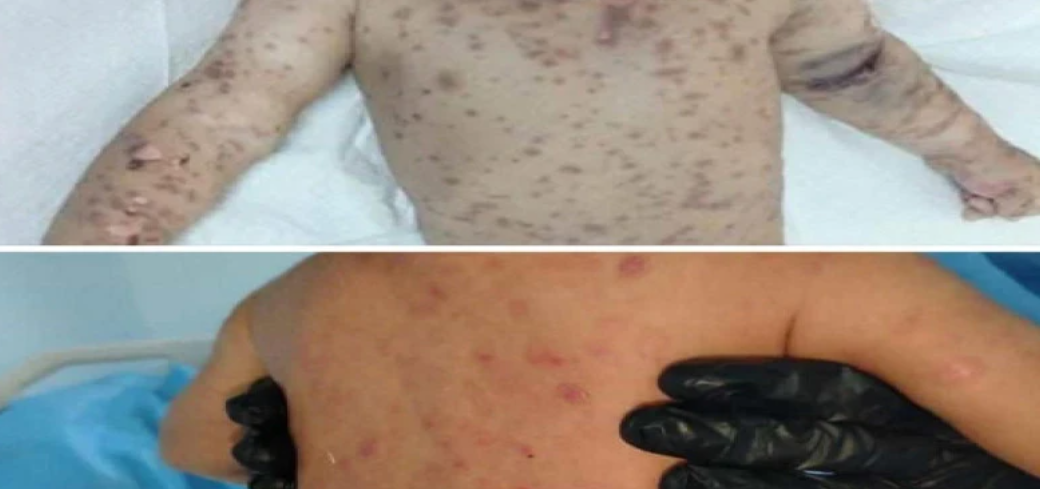 صحة بابل: إنقاذ طفل مصاب بداء نادر يهدد الحياة