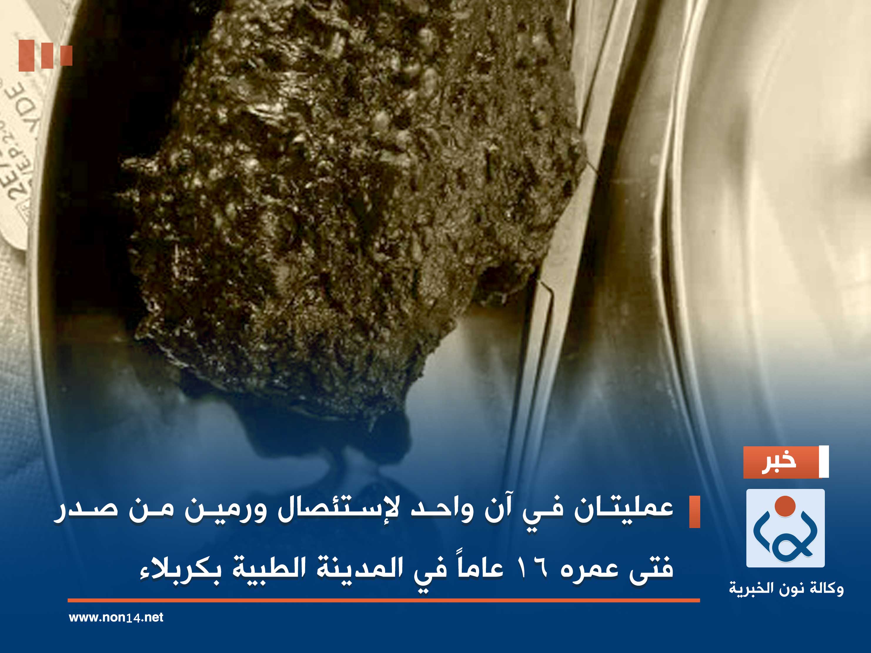 عمليتان في آن واحد لإستئصال ورمين من صدر فتى عمره 16 عاماً في المدينة الطبية بكربلاء