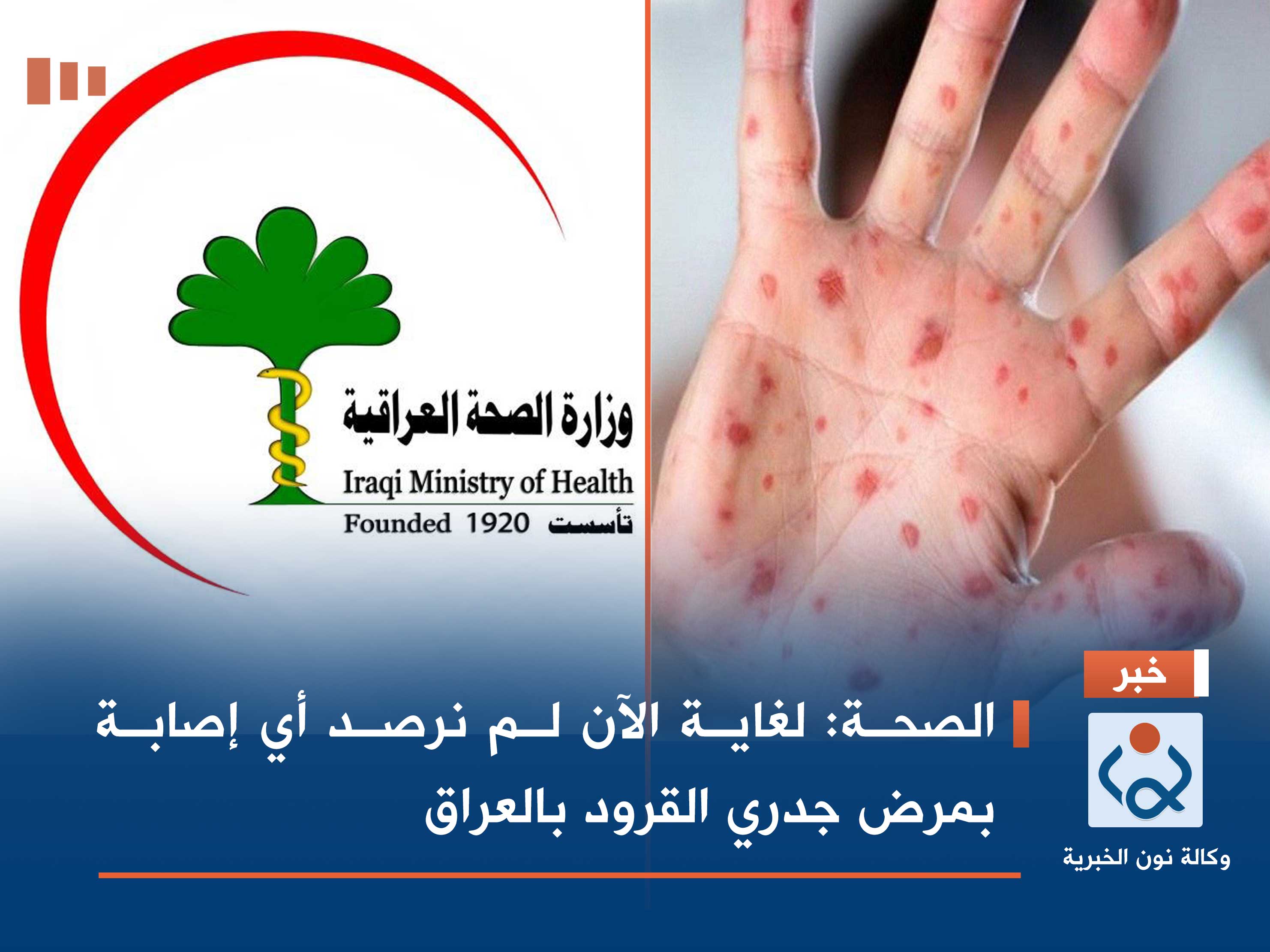 الصحة: لغاية الآن لم نرصد أي إصابة بمرض جدري القرود بالعراق