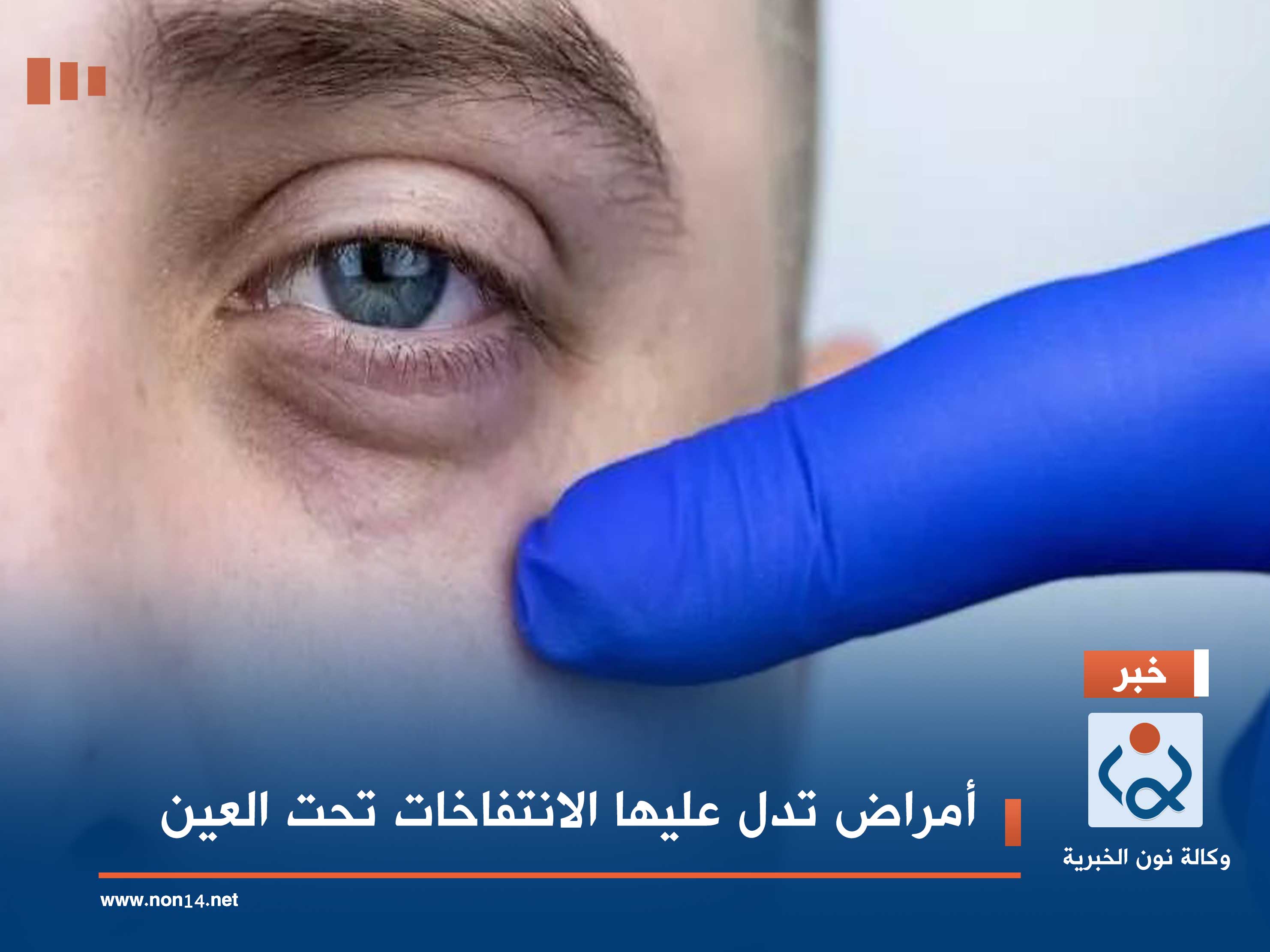 أمراض تدل عليها الانتفاخات تحت العين