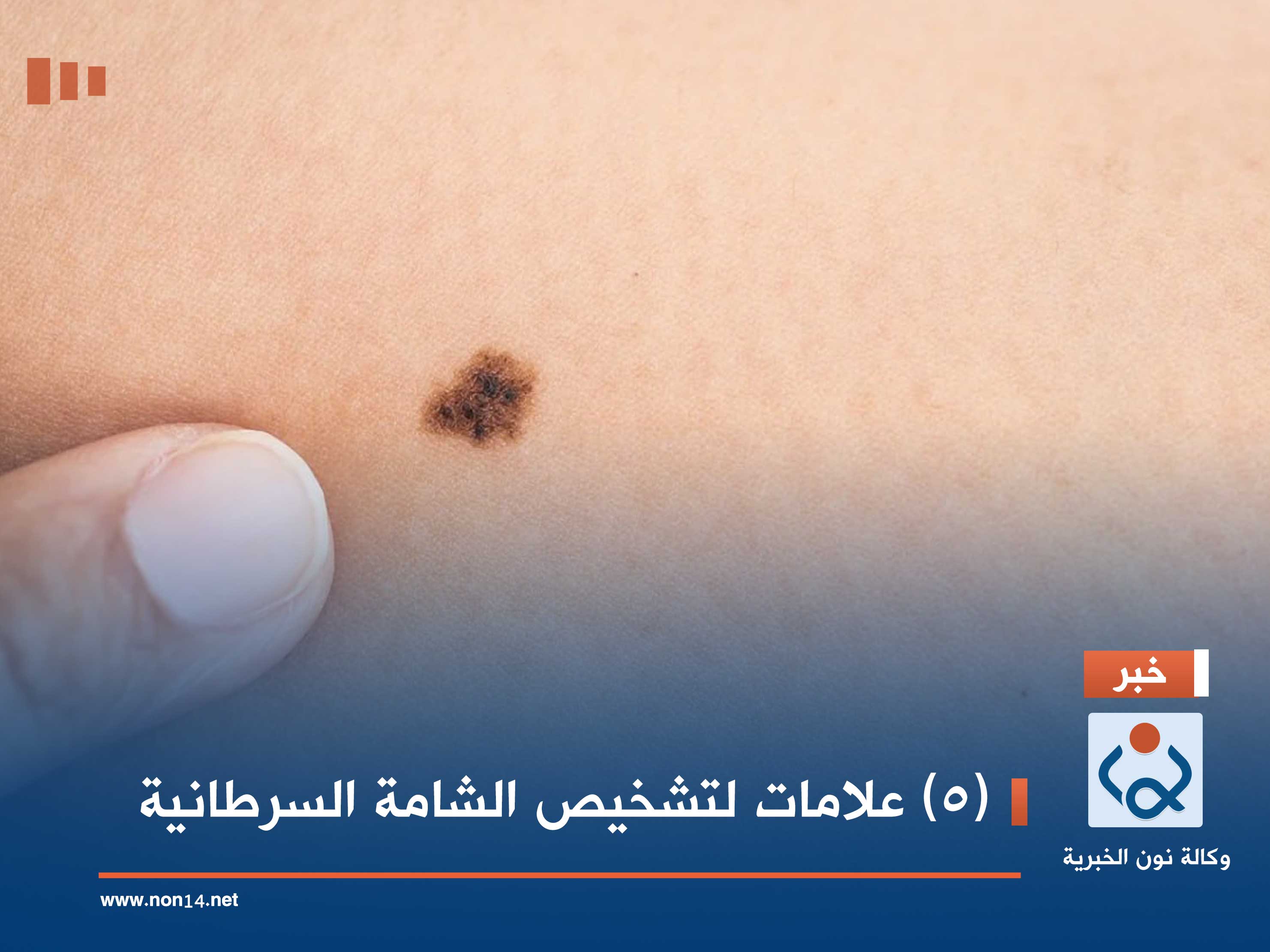 (5) علامات لتشخيص الشامة السرطانية