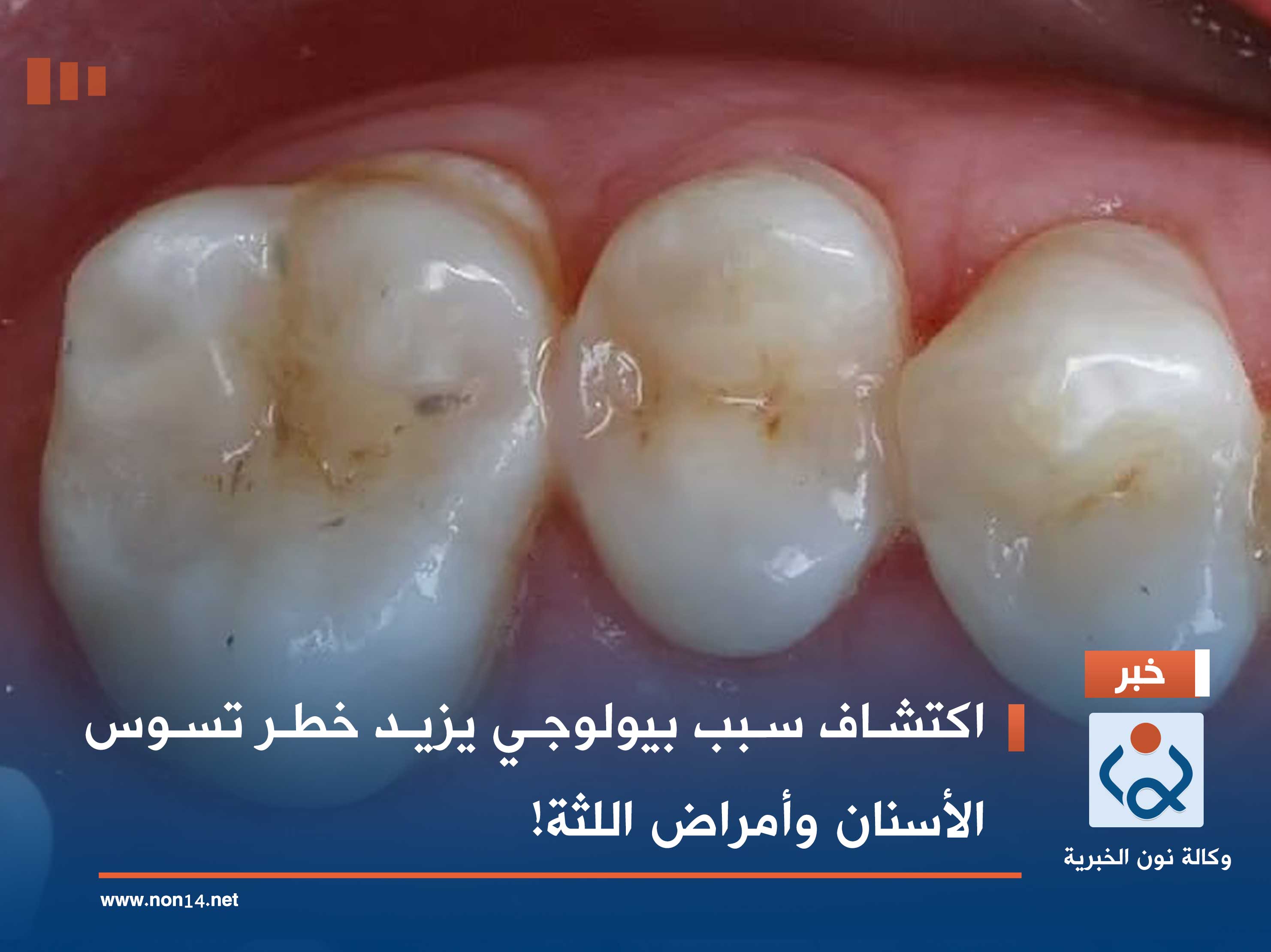 اكتشاف سبب بيولوجي يزيد خطر تسوس الأسنان وأمراض اللثة!