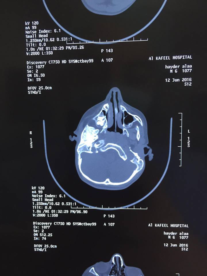 زراعة مفصل فك لطفل من احد إضلاعه في مستشفى الكفيل بكربلاء (مصور)