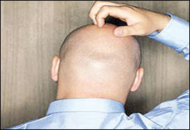 اکتشاف جين قد يقود لعقاقير جديدة لعلاج الصلع