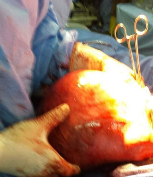 فريق طبي كربلائي ينجح في إستئصال ورم وزنه 2 كغم من بطن سيدة بعمر 43 عاماً