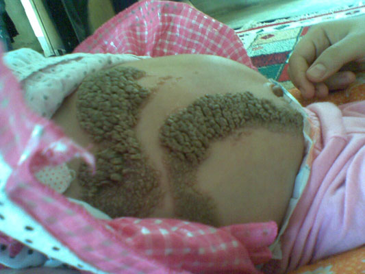 طفلة عراقية تناشد المسؤولين والخيرين  لعلاجها من حالة مرضية نادرة