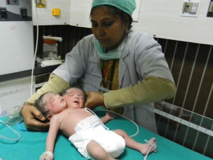 طفلة برأسين ورقبتين وجسم واحد