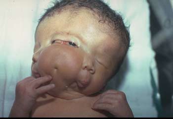 عائلة طفلة هندية ولدت بوجهين ترفض أي رعاية خاصة