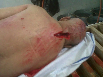 جثة الشهيد البحريني حسن الستري واثار التعذيب على جسده (مصور)