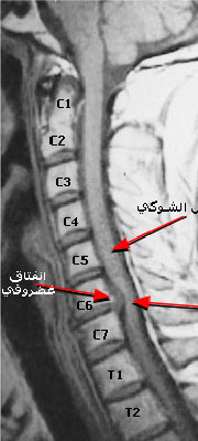 عراقي يحصل على براءة اختراع لجهاز خاص بالفقرات القطنية