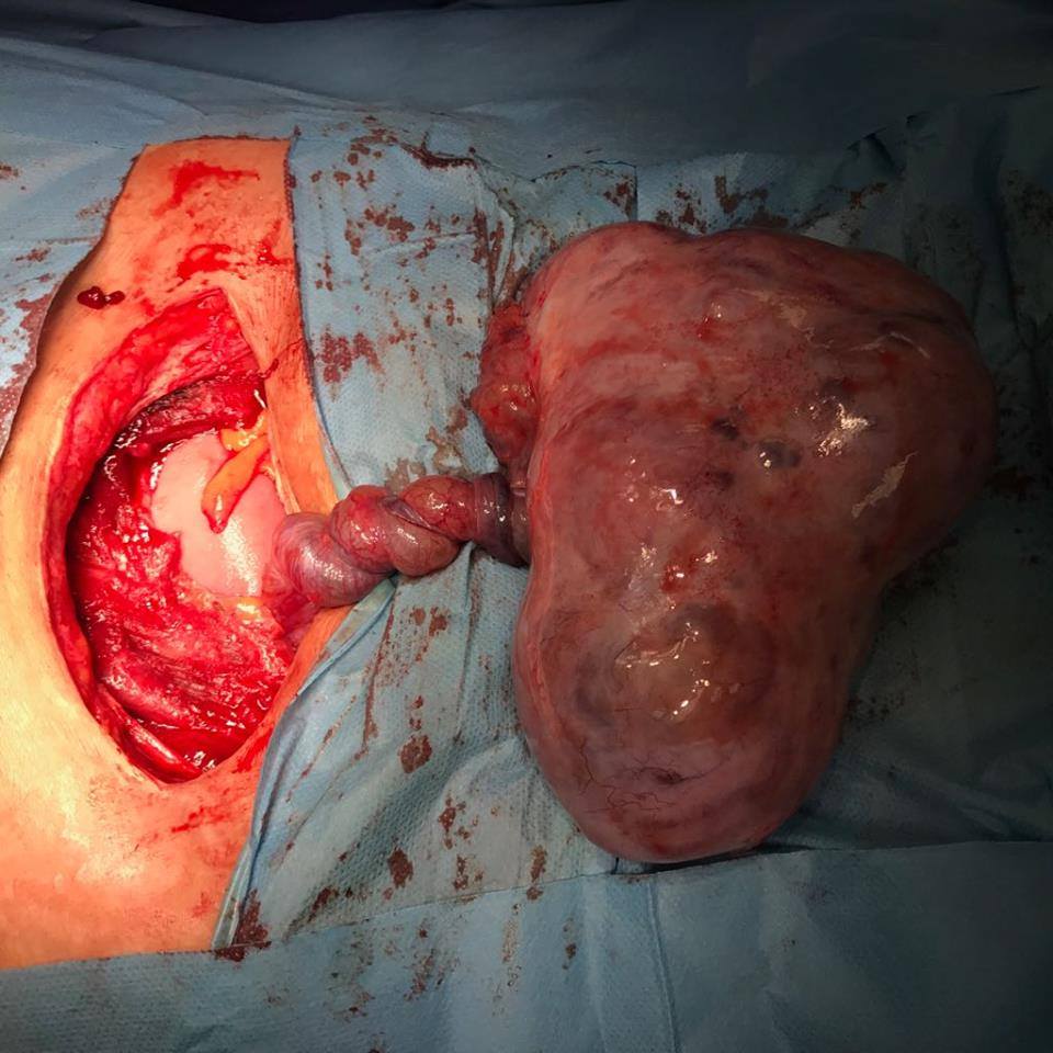 كربلاء: فريق للجراحة النسائية في مستشفى الإمام زين العابدين عليه السلام يجري عملية نادرة باستئصال كيسة عجائبية ملتفة على مبيض مريضة