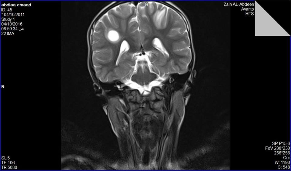 كربلاء: إنقاذ حياة طفل من محافظة دهوك مصاب بمرض نادر في الدماغ والنخاع في مستشفى الإمام زين العابدين (صور)