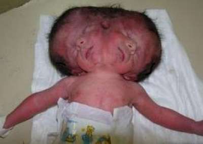 صحيفة أمريكية تنشر تقريرا مفجعا عن آثار التشوهات بالسلاح الأمريكي القذر ضد العراقيين.. مصور