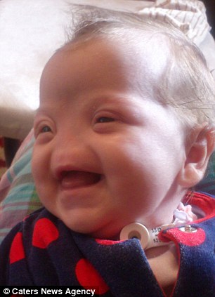 شاهد بالصور:طفلة بدون أنف