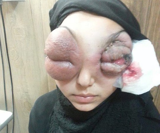 الشيخ عبد المهدي الكربلائي يوعز بعلاج طفلة عراقية تعاني من اورام غريبة في عينيها