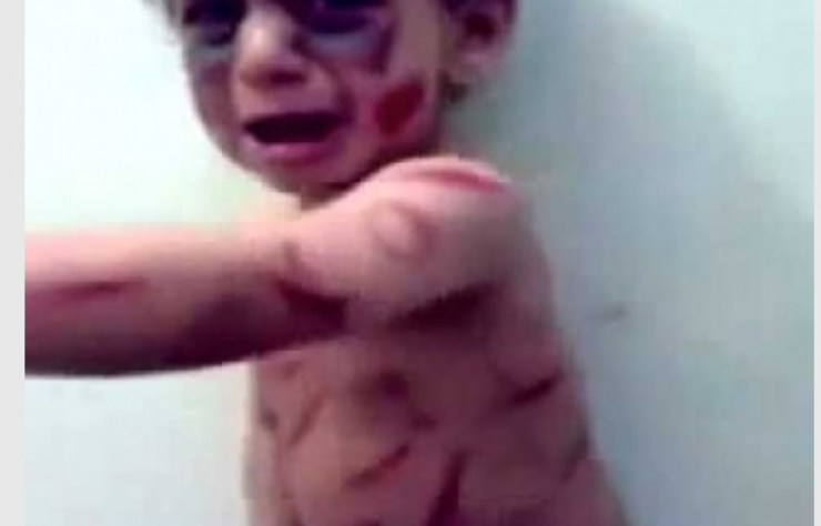 بالصور:ام عراقية تحرق جسد ابنها وتكسر ذراعه والسبب!!