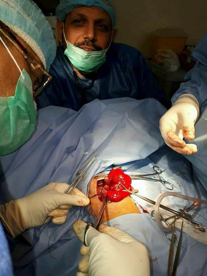 عملية نادرة والأُولى من نوعها في كربلاء لطفلة رضيعة مُصابة بتشوه ولادي في الرئة اليسرى