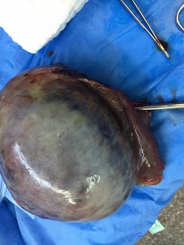 عملية جراحية ناجحة في مستشفى النسائية والتوليد التعليمي بكربلاء تستأصل ورماَ حجمه ( ١٢x١٦ ) سم من بطن سيدة عشرينية