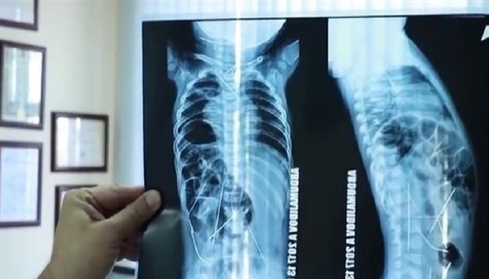 إزالة 16 إبرة خياطة من داخل جسم طفل رضيع