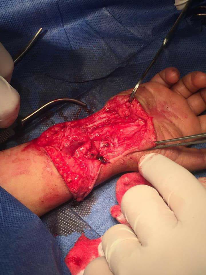 كربلاء:انقاذ يد طفل بعمر اربع سنوات من البتر من خلال عملية جراحية معقدة(مصور)