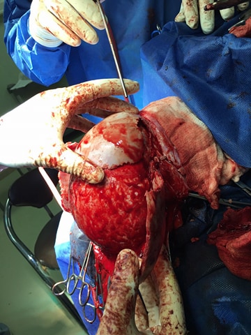 بالصور:إستئصال ورم كبير من رقبة طفل حديث الولادة في مدينة الإمام الحسين (ع) الطبية بكربلاء