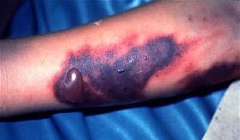 الزراعة: الإصابات التي ظهرت بمرض الحمى النزفية محدودة جدا ومسيطر عليها