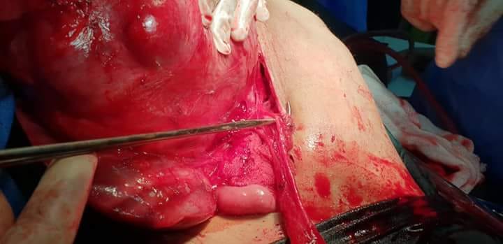 كربلاء :استأصال ورم كبير من كبد طفل تنهي معاناته مع المرض إستمرت لنحو خمسة سنوات (مصور)