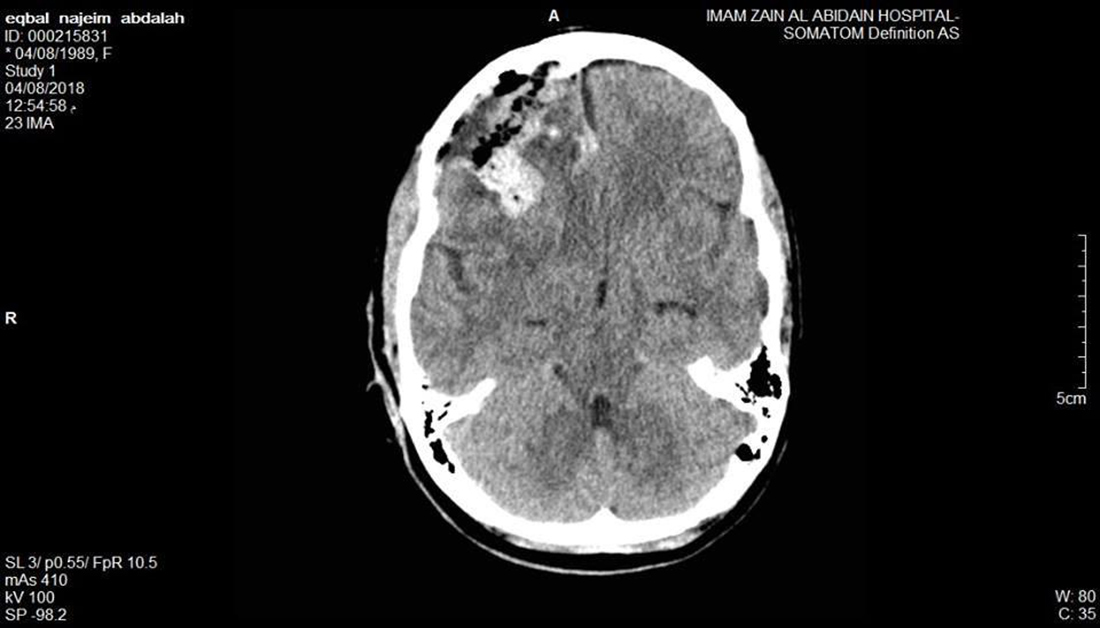 كربلاء:استئصال ورم من مريضة عشرينية في مستشفى تابع للعتبة الحسينية