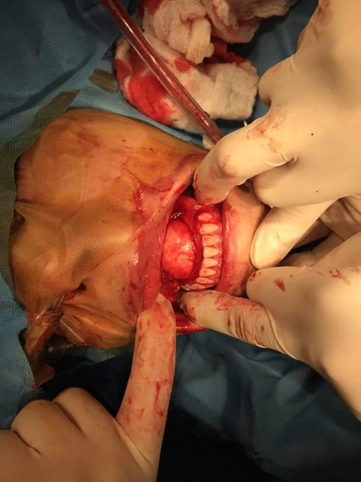 كربلاء :إستئصال ورم كبير أسفل بلعوم مريضة بعمر ( 17 ) عشر عاما(صور)