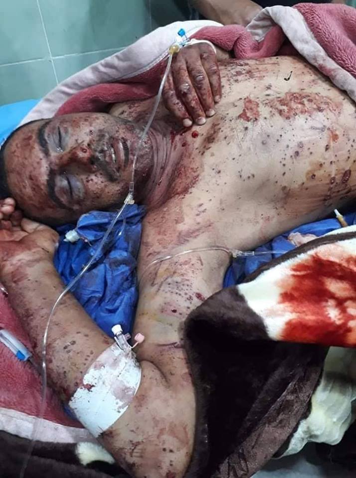 إصابة أحد منتسبي المديرية العامة لنقل طاقة الشمال بعبوة ناسفة أثناء الواجب