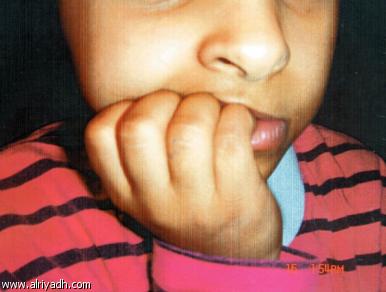 كويتي يشوه وجه طفلته انتقاما من زوجته