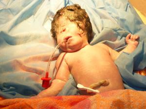 مستشفى النسائية والتوليد في كربلاء تشهد ولادة طفلة بعين واحدة ومن دون انف + صورة