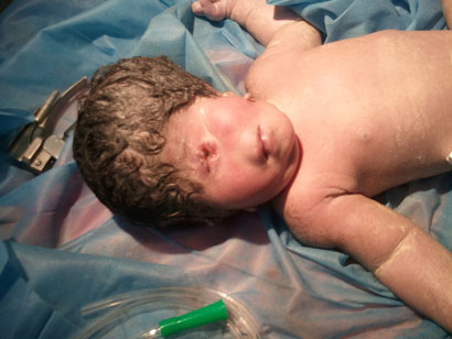 صورة مقربة لطفلة ولدت بعين واحدة فقط ومن دون انف في كربلاء