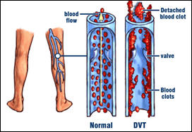 دراسة تربط بين تلوث الهواء وتکون جلطات الدم