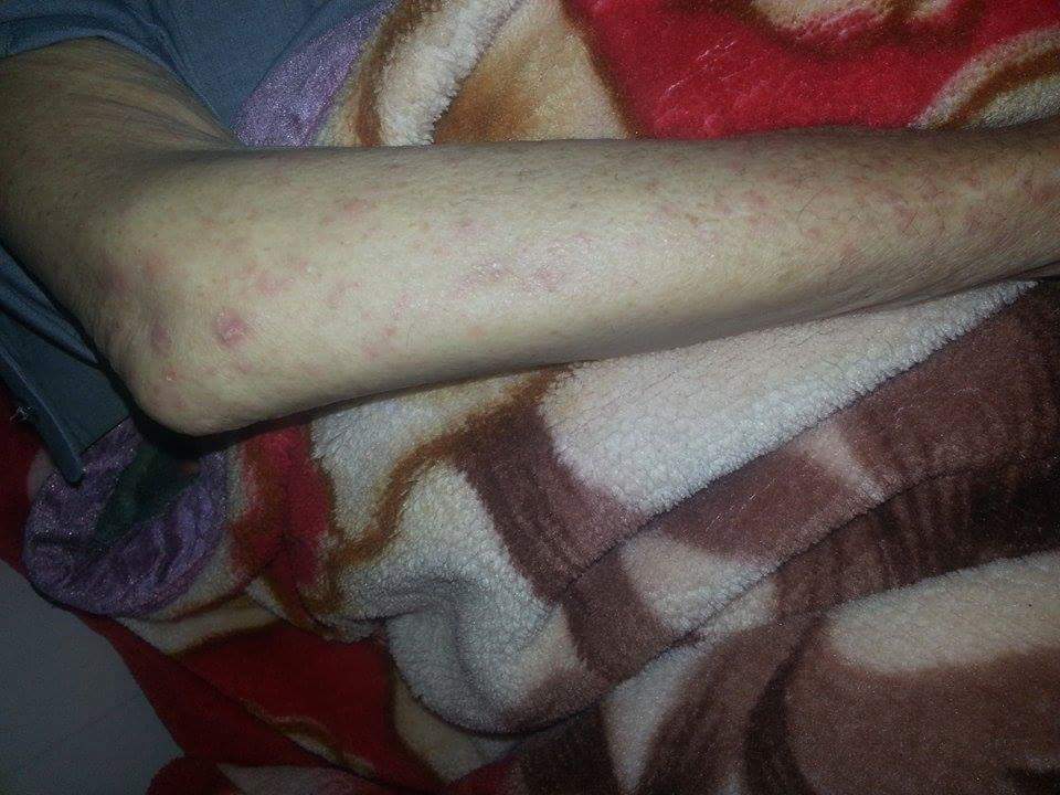 بالصور:حالات لوباء الجرب بين سكان النازحين في كربلاء